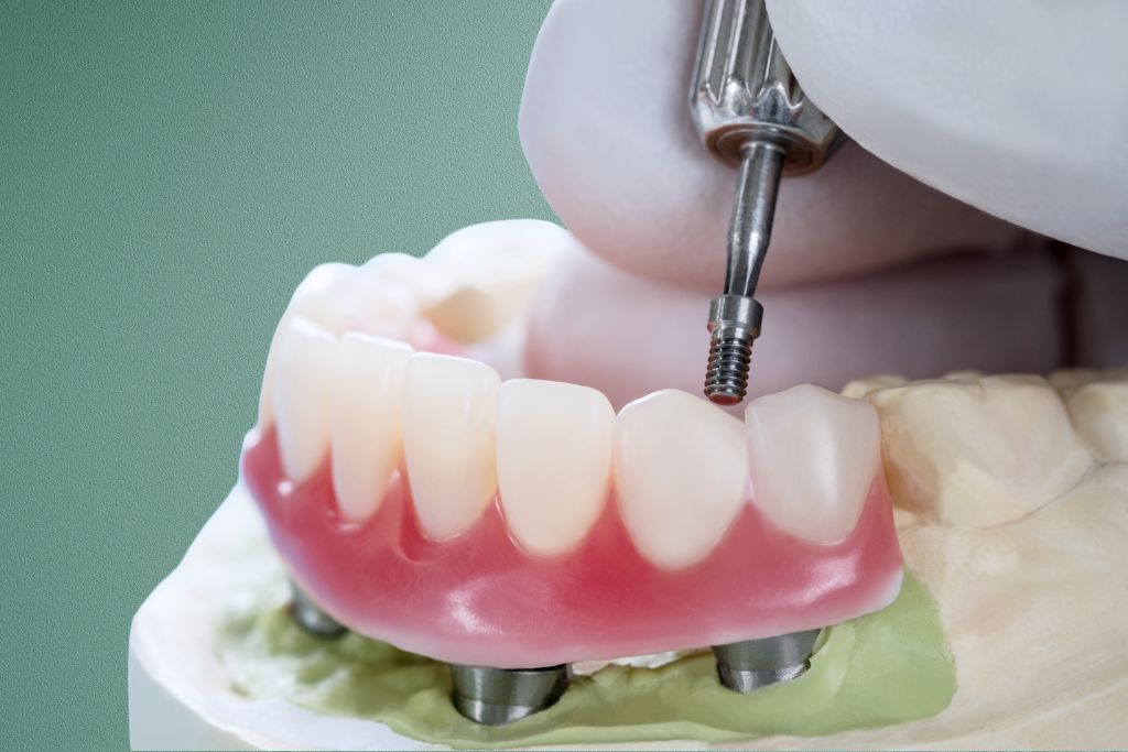 overdentures