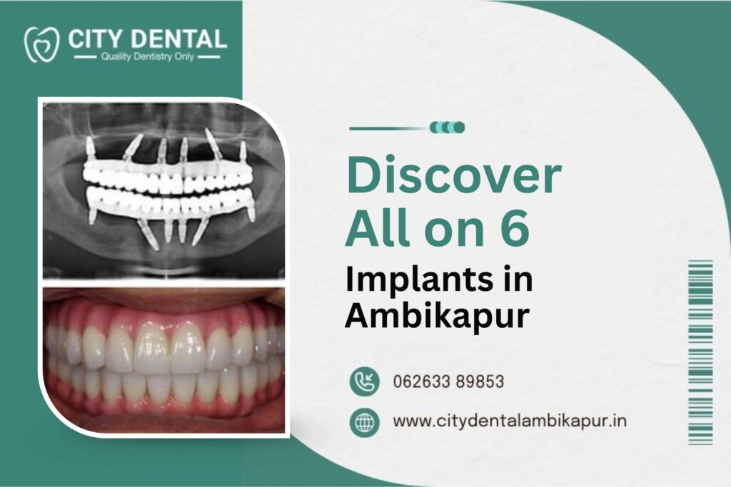 Discover All on 6 Implants in Ambikapur