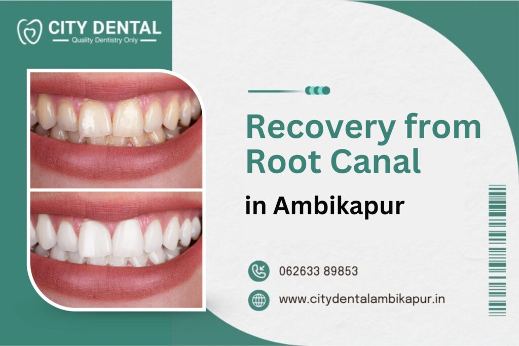 Recovery from Root Canal Treatment